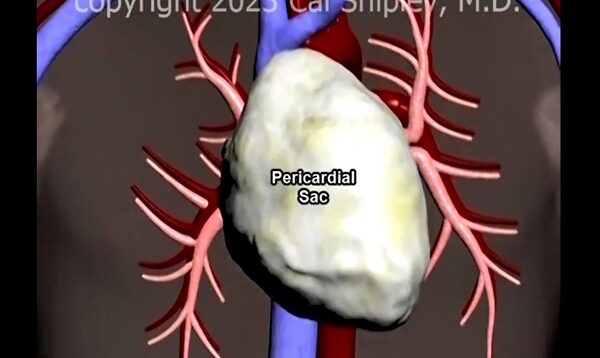 Aortic Dissection and Cardiac Tamponade