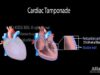 Cardiac Tamponade Pathophysiology Etiology Symptoms