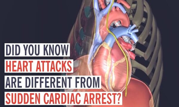 Heart Attack vs Cardiac Arrest What s the Difference