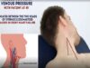 Measuring Jugular Venous Pressure JVP OSCE Guide Clip UK