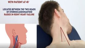 Measuring Jugular Venous Pressure JVP OSCE Guide Clip UK