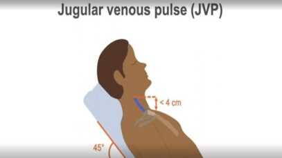 Measuring the jugular venous pulse