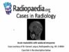 Acute mastoiditis with subdural empyema Radiopaedia org Cases