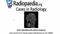 Acute mastoiditis with subdural empyema Radiopaedia org Cases