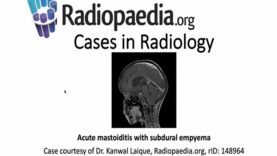 Acute mastoiditis with subdural empyema Radiopaedia org Cases