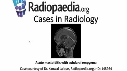 Acute mastoiditis with subdural empyema Radiopaedia org Cases