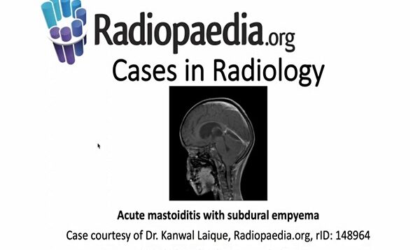 Acute mastoiditis with subdural empyema Radiopaedia org Cases