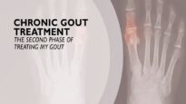 Chronic Gout Treatment The Second Phase of Treating Gout 6 of