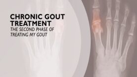 Chronic Gout Treatment The Second Phase of Treating Gout 6 of