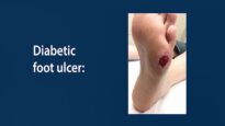 Diabetic Foot Care