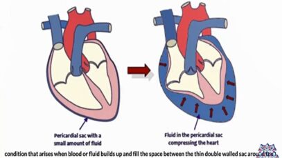 Pericardial Tamponade Everything You Need To Know