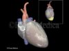 Pericardial effusion Heart