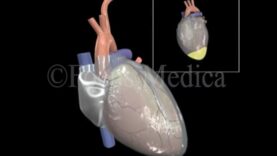 Pericardial effusion Heart