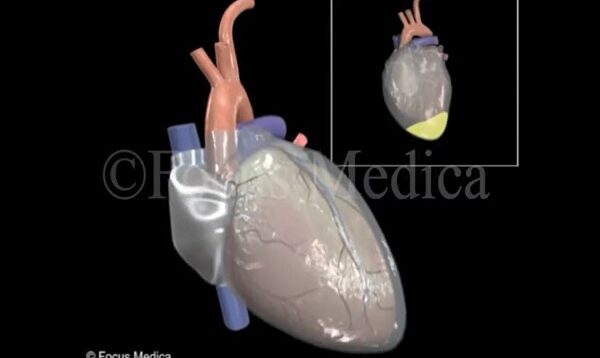 Pericardial effusion Heart
