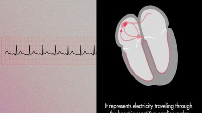 The Cardiac Cycle on an EKG P QRS T Waves