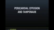 Ultrasound Podcast PERICARDIAL TAMPONADE LEARN THIS