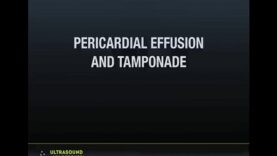 Ultrasound Podcast PERICARDIAL TAMPONADE LEARN THIS