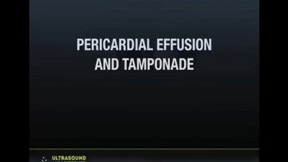 Ultrasound Podcast PERICARDIAL TAMPONADE LEARN THIS