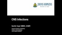 Imaging in CNS infections