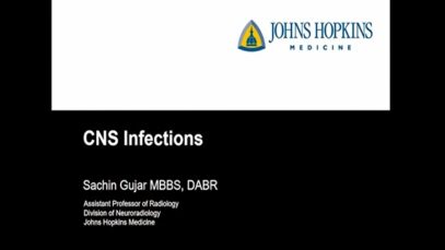 Imaging in CNS infections