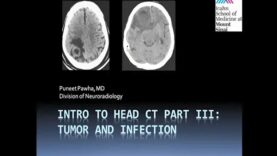 Intro to Head CT Part III_ Tumor and Infection