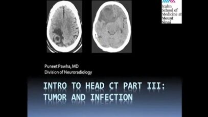 Intro to Head CT Part III_ Tumor and Infection