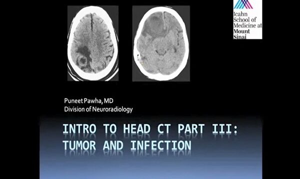 Intro to Head CT Part III_ Tumor and Infection