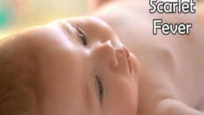 Scarlet Fever Symptoms, Treatment, and Causes