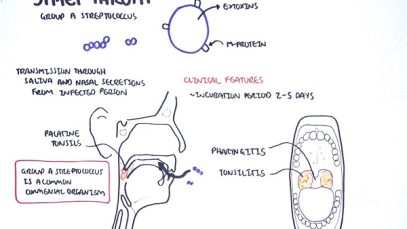 Strep throat streptococcal pharyngitis pathophysciology, sign