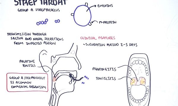 Strep throat streptococcal pharyngitis pathophysciology, sign