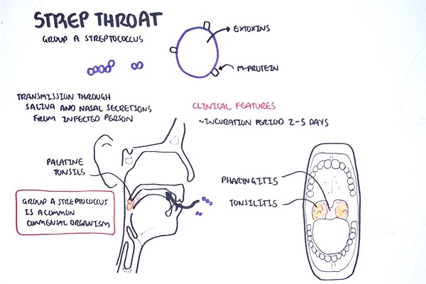 Strep throat streptococcal pharyngitis pathophysciology, sign