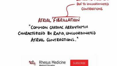 Atrial Fibrillation Made Easy