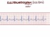Electrocardiography (ECG_EKG) – basics