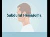 Understanding Subdural Hematoma