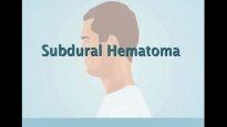 Understanding Subdural Hematoma