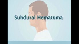 Understanding Subdural Hematoma