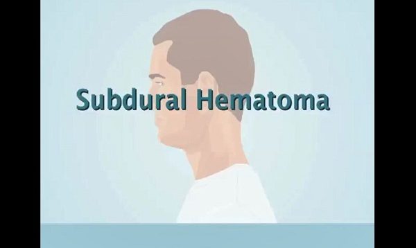 Understanding Subdural Hematoma