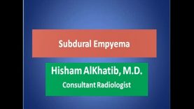subdural empyema