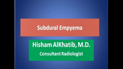 subdural empyema
