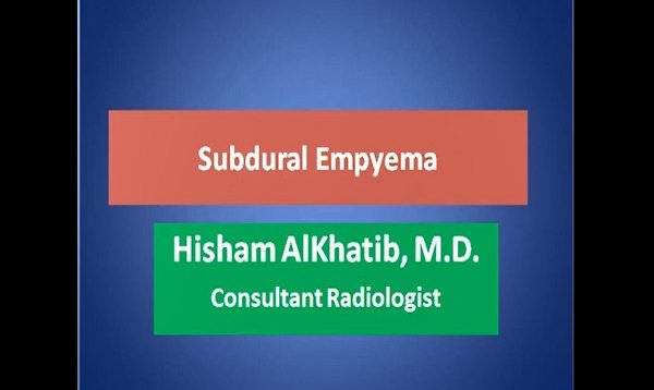 subdural empyema