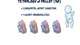 Tetralogy of Fallot