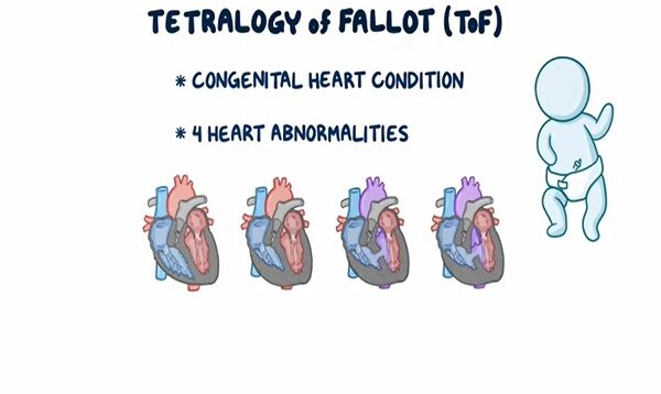 Tetralogy of Fallot