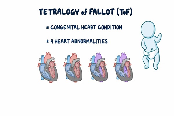 Tetralogy of Fallot