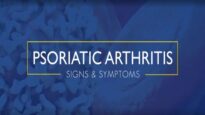 Psoriatic Arthritis Signs and Symptoms