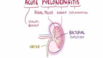 Acute pyelonephritis urinary tract infection causes, symptom