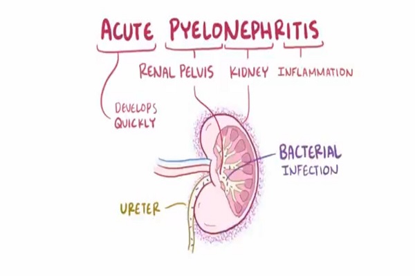 Acute pyelonephritis urinary tract infection causes, symptom