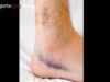 Ankle Sprain