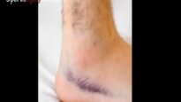 Ankle Sprain
