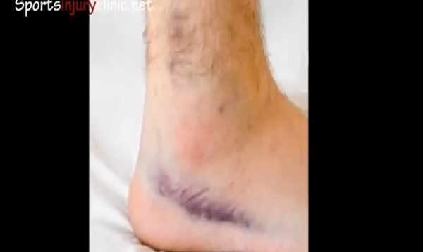Ankle Sprain