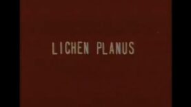 Lichen Planus